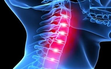 Symptoms of osteochondrosis of the cervical column