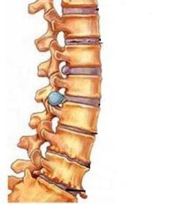 How the osteochondrosis of the cervical region develops