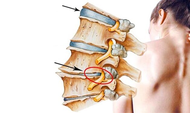 Pinched nerve in the spine as a cause of low back pain.