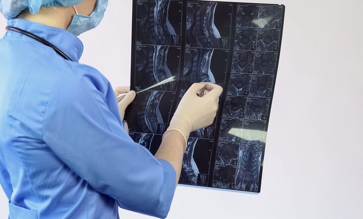 The diagnosis of cervical osteochondrosis is made on the basis of an MRI study. 