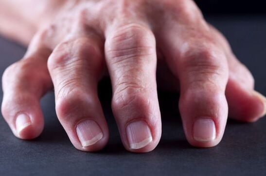Joint deformities of the fingers due to osteoarthritis or arthritis. 